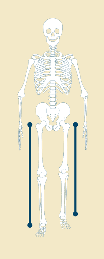 Skeleton diagram showing unequal leg lengths